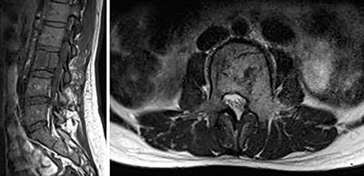 Imaging Findings and Clinical Features of Primary Spinal Epithelioid Hemangioendothelioma